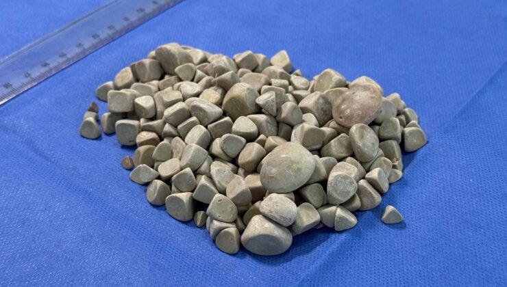 İstanbul’da 287 Taşla Şaşkınlık Yaşatan Nadiren Görülen Ekstrofi Vezika Vakası